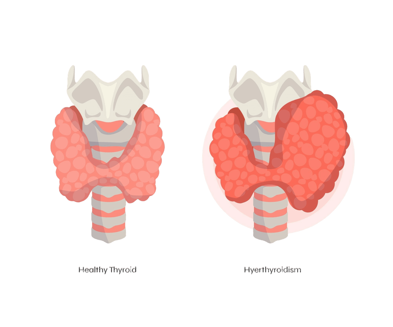 Thyroid disease Thyroid disease